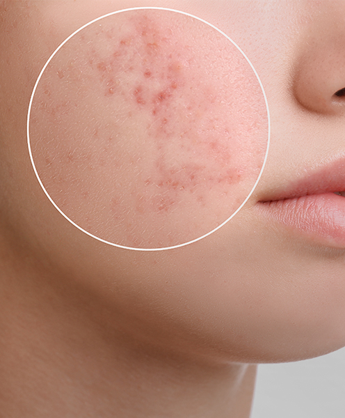 What Causes Acne Scars?